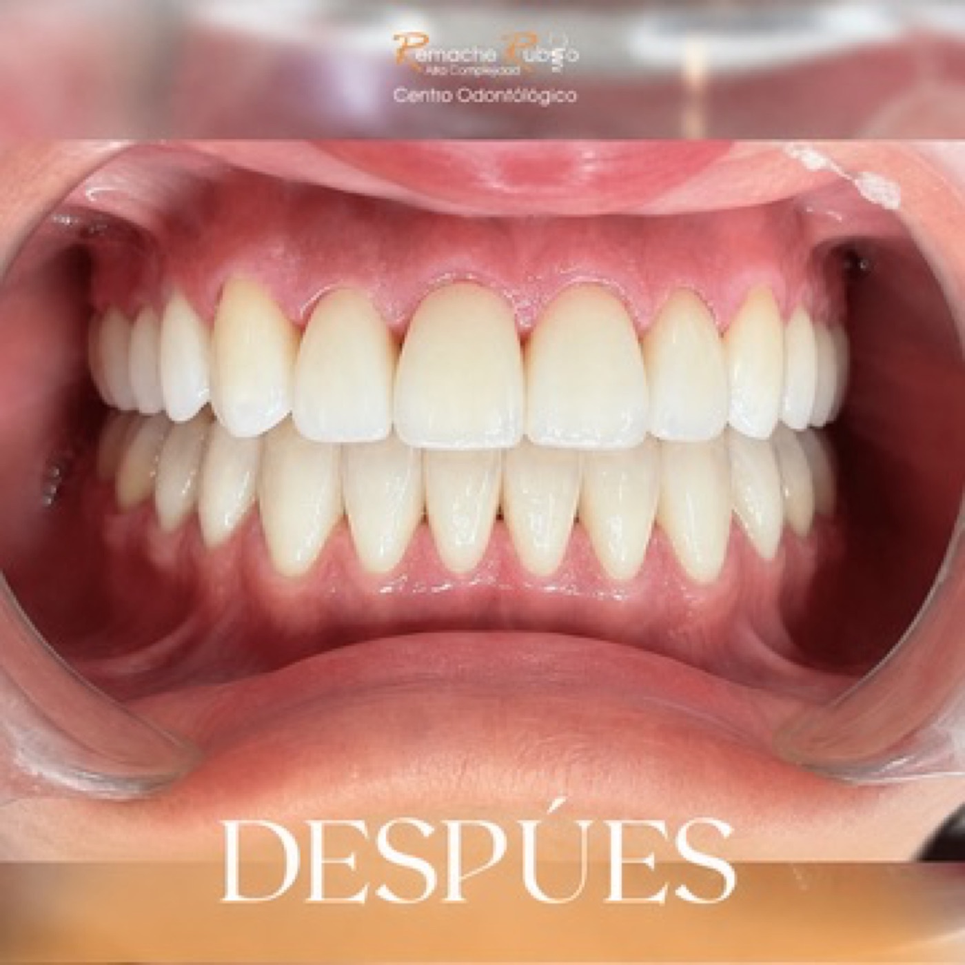 Diseño de sonrisa