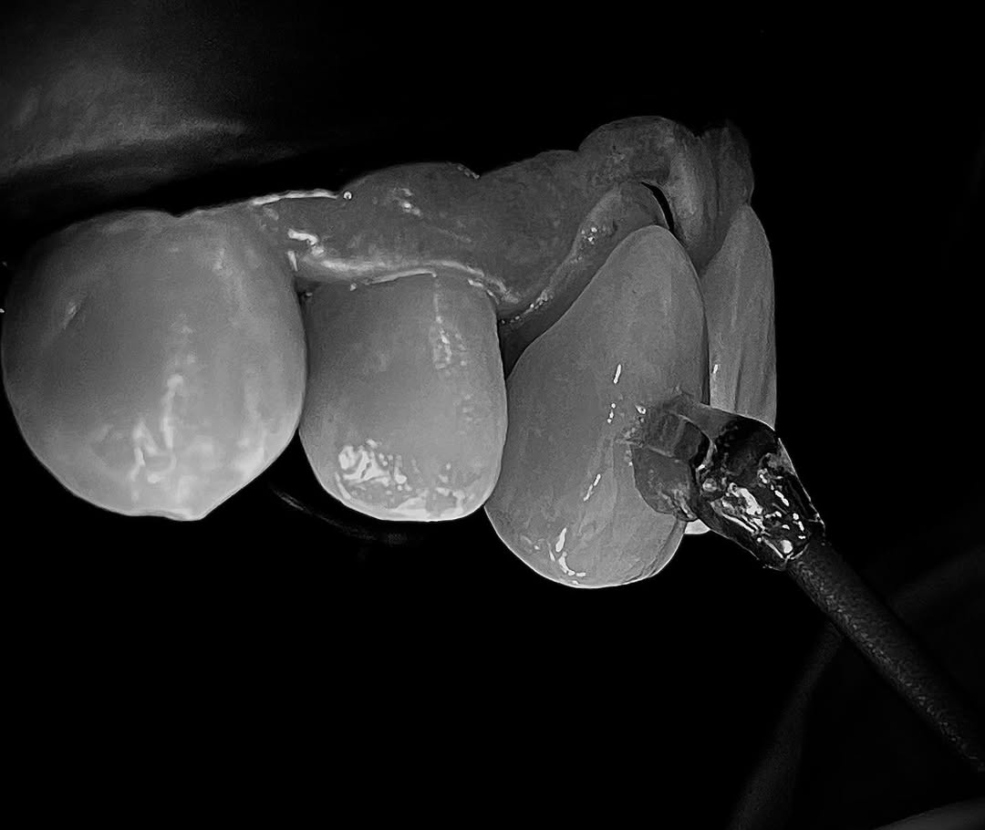 Proceso clínico de colocación de carillas dentales