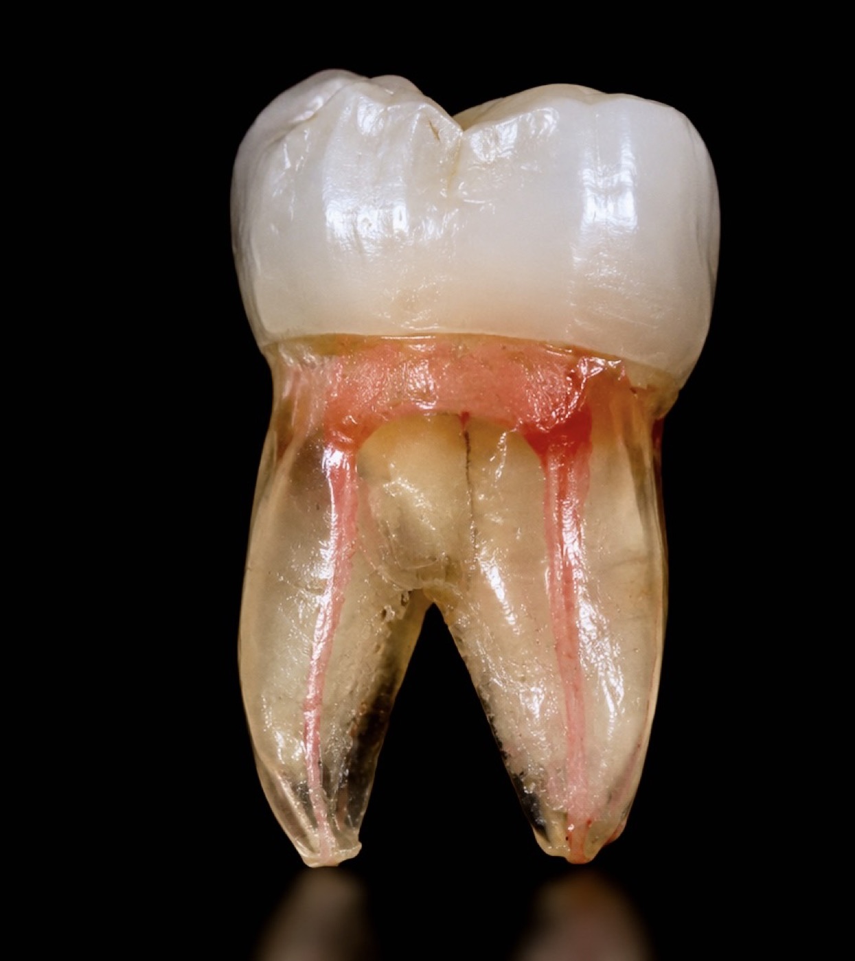 Raíz dental con el conducto (nervio) afectado