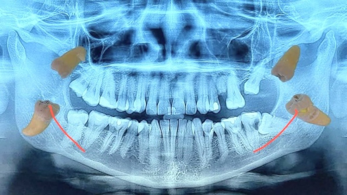 Extracción de terceros molares — radiografía panorámica