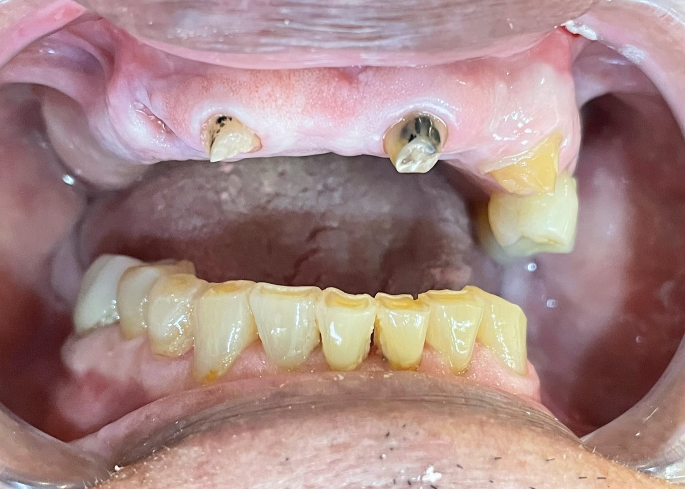 Antes: piezas dentales perdidas — diagnóstico inicial del caso