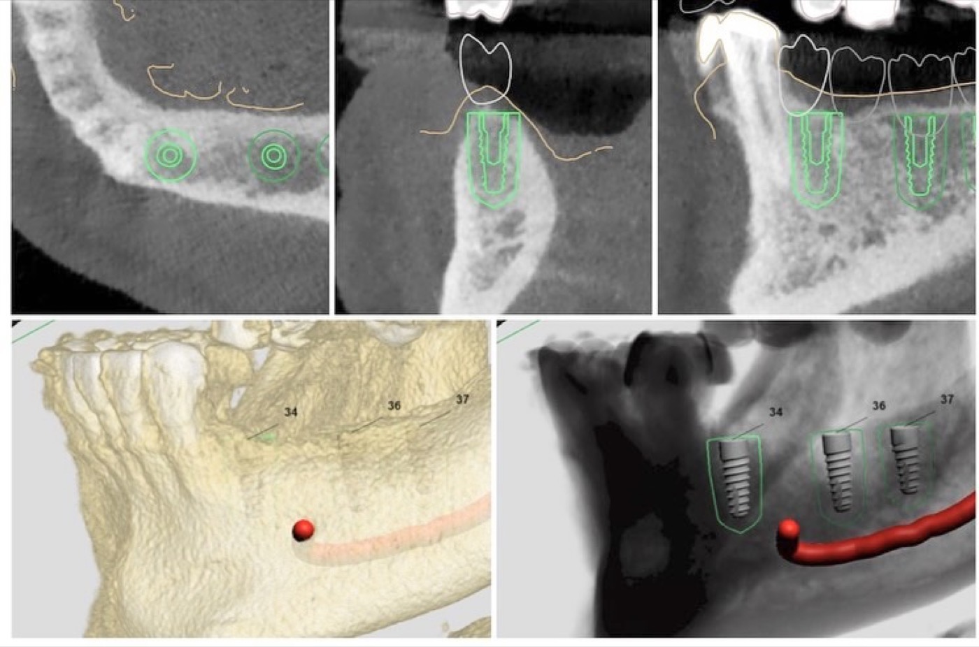 Planificación digital 3D con cirugía guiada para la colocación de implantes