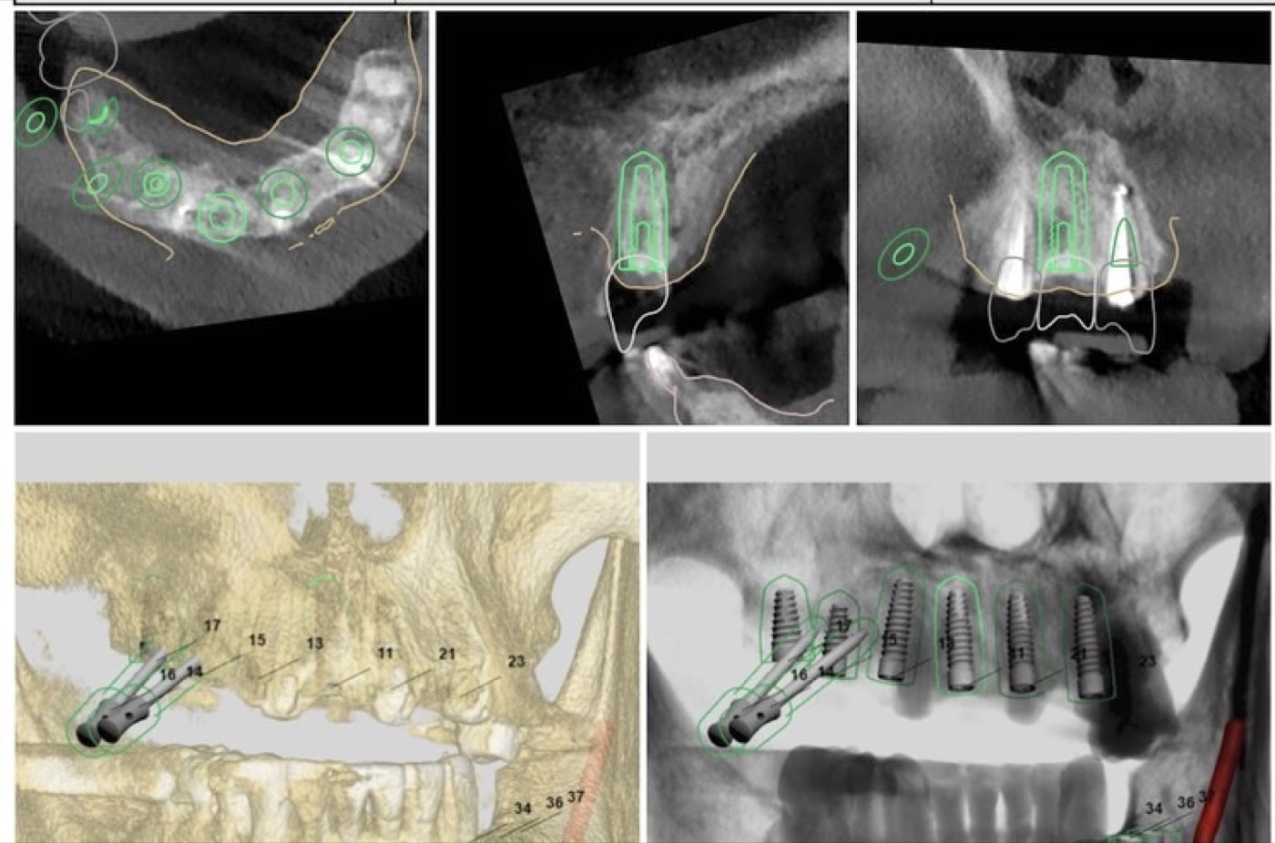 Planificación digital de implantes múltiples sobre tomografía 3D
