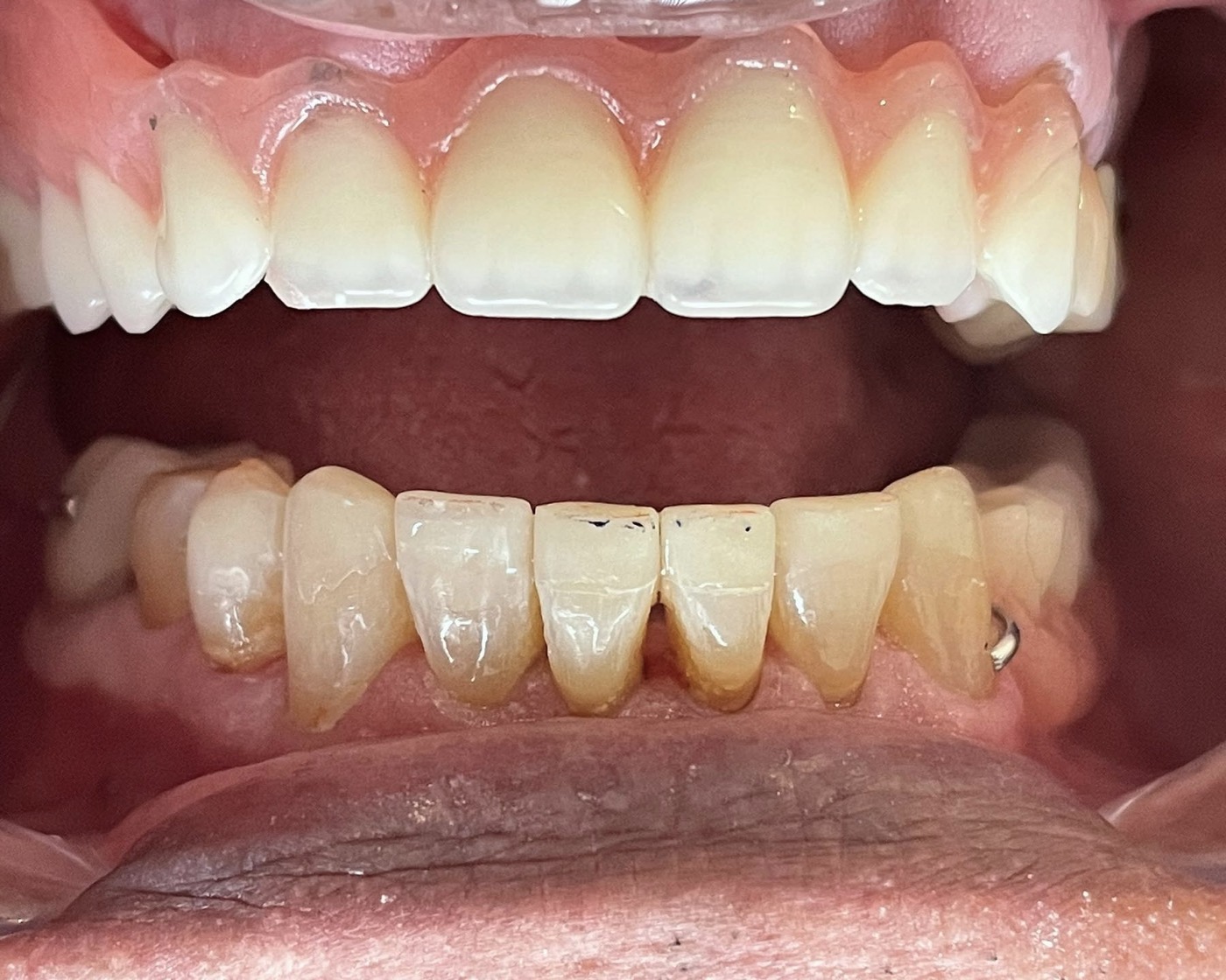 Prótesis provisional sobre implantes durante el tratamiento