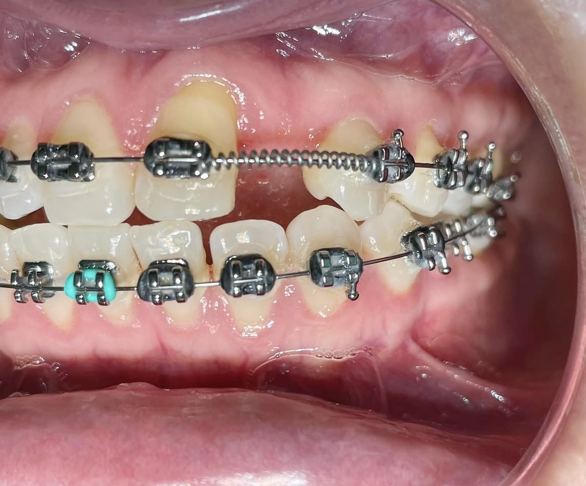 Caso de ortodoncia — alineación dental con brackets