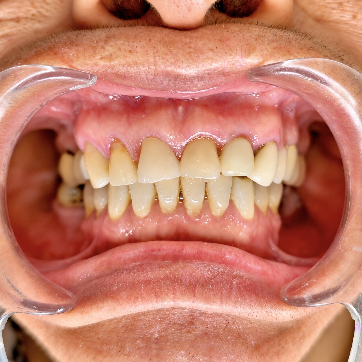 Resultado final: prótesis dental completa y funcional en boca del paciente