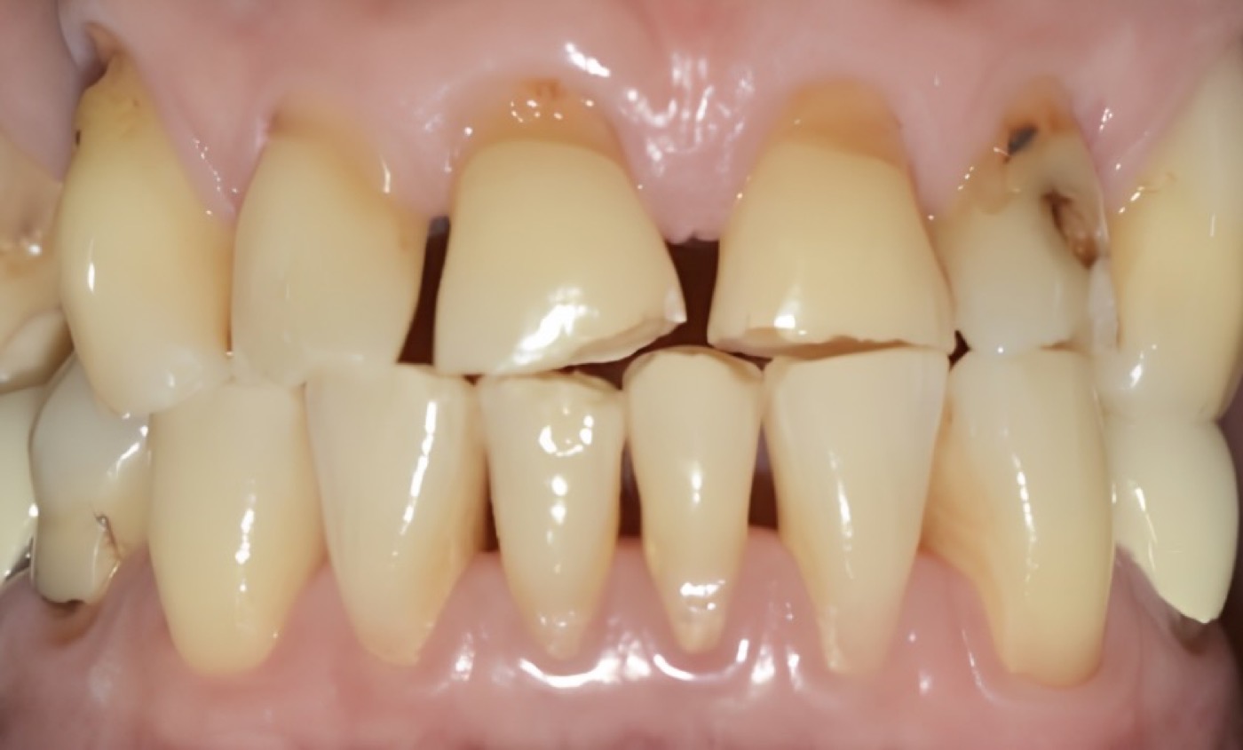 Antes: dientes muy desgastados y deteriorados — caso real de rehabilitación oral
