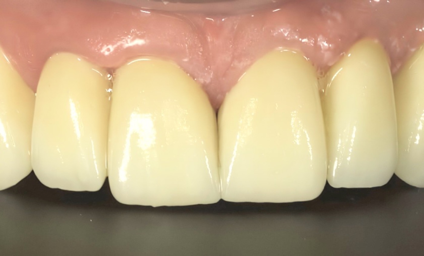 Proceso de colocación de la prótesis dental