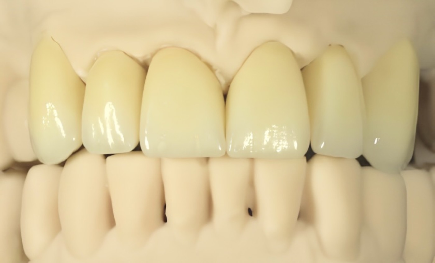 Prótesis dental fabricada a medida para el caso