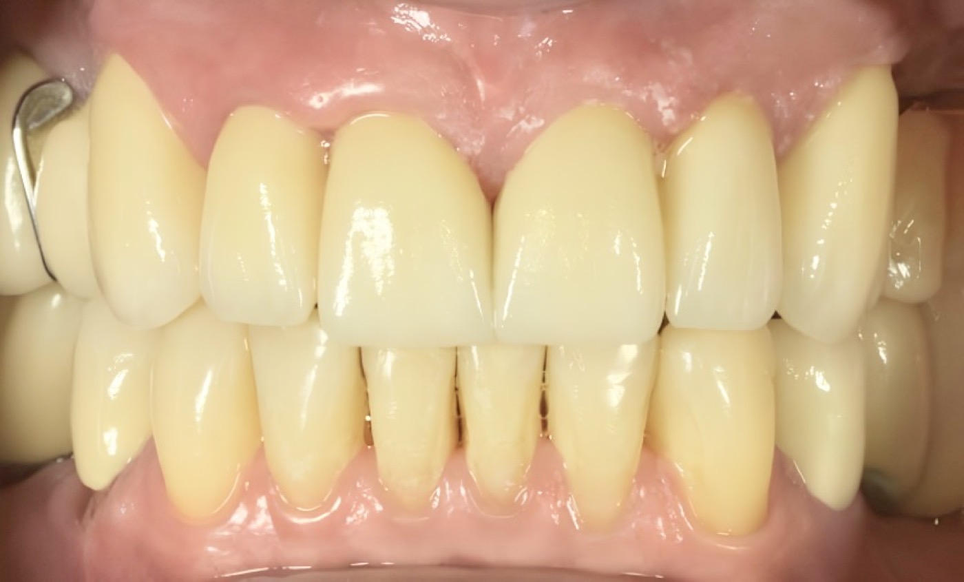 Resultado final: sonrisa restaurada, dientes blancos y armónicos