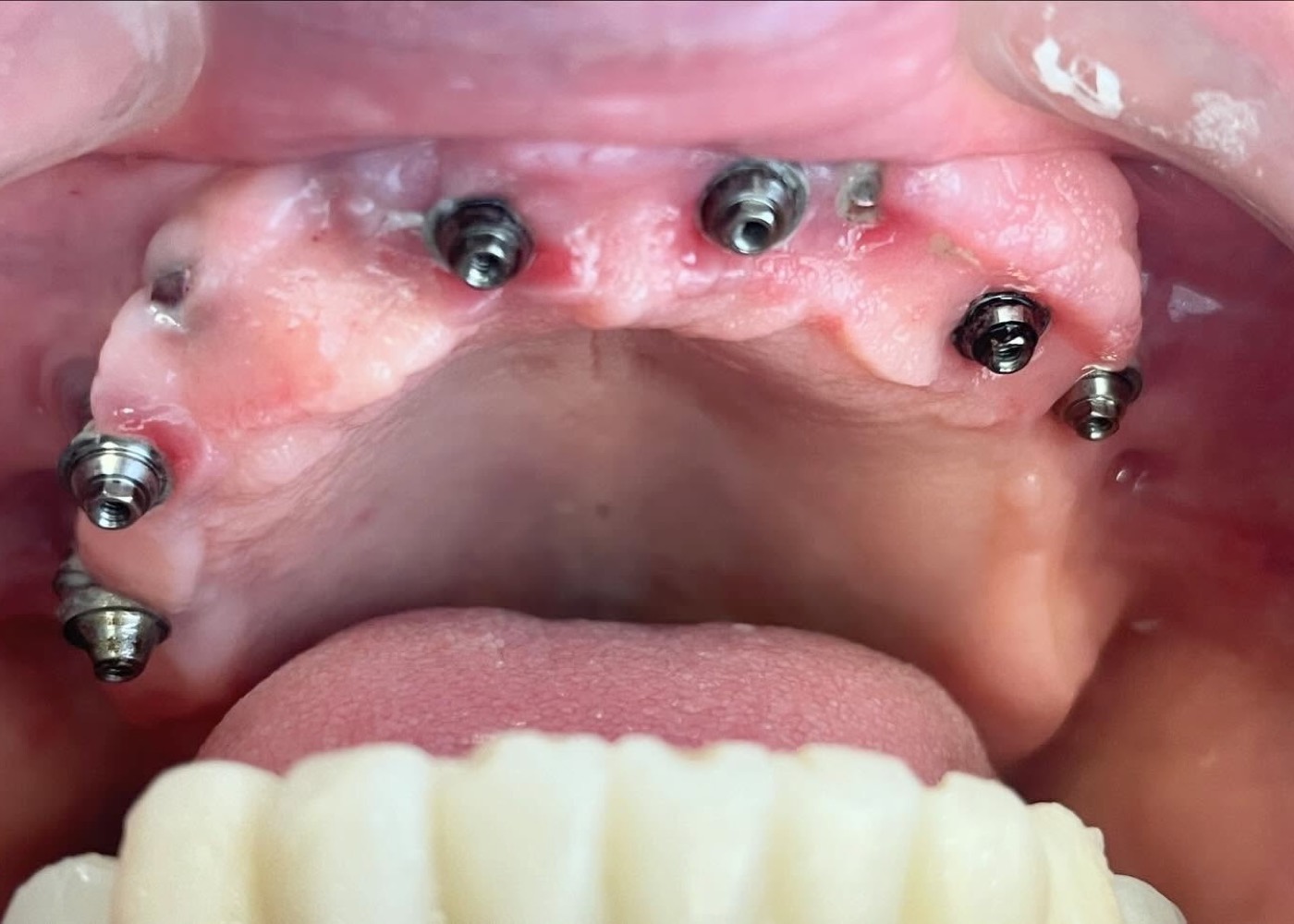 Colocación quirúrgica de implantes múltiples en el maxilar