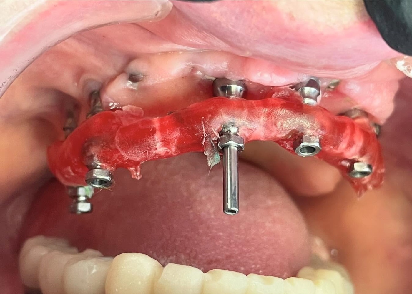 Prueba de estructura metálica sobre los implantes