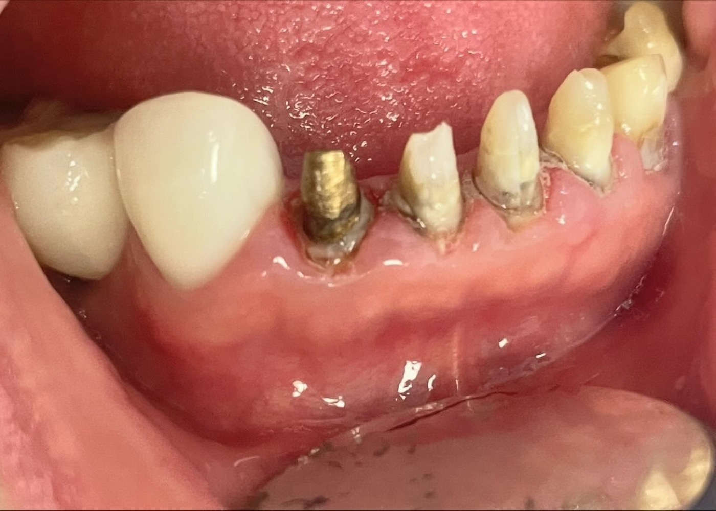 Restauración progresiva pieza por pieza sobre implantes