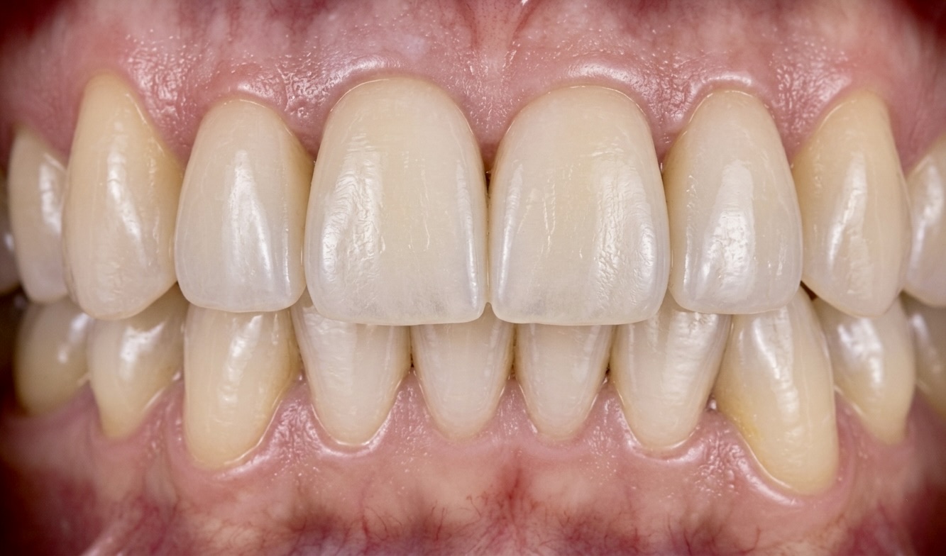 Después: sonrisa armónica y natural tras el diseño de sonrisa