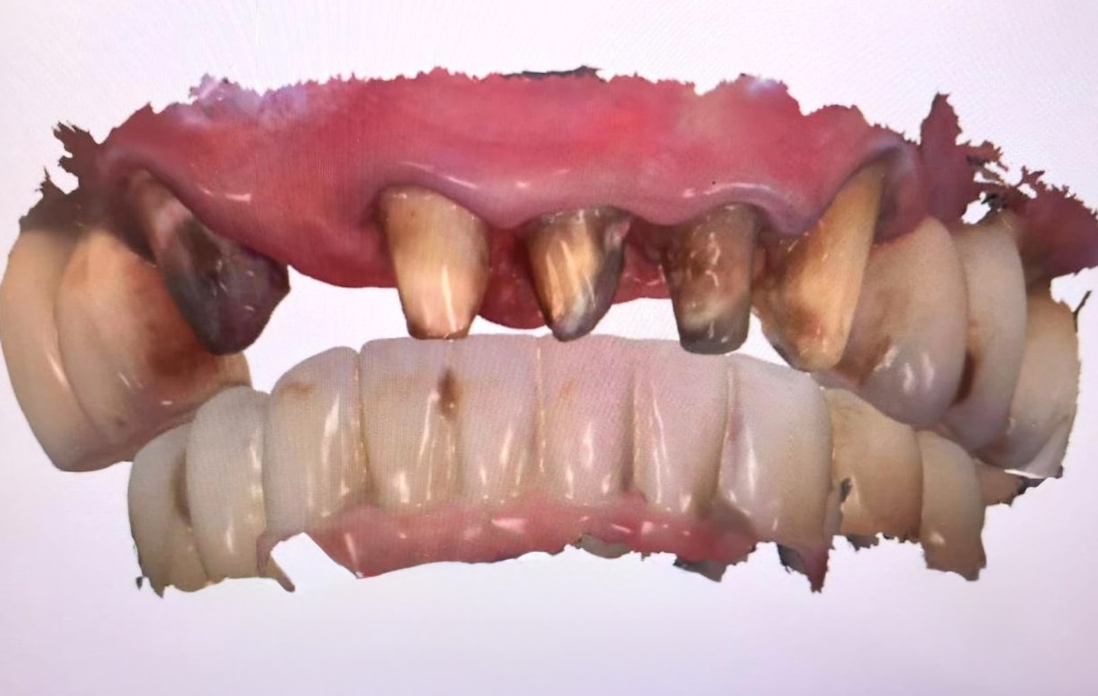 Modelo 3D del escaneo intraoral mostrado en pantalla