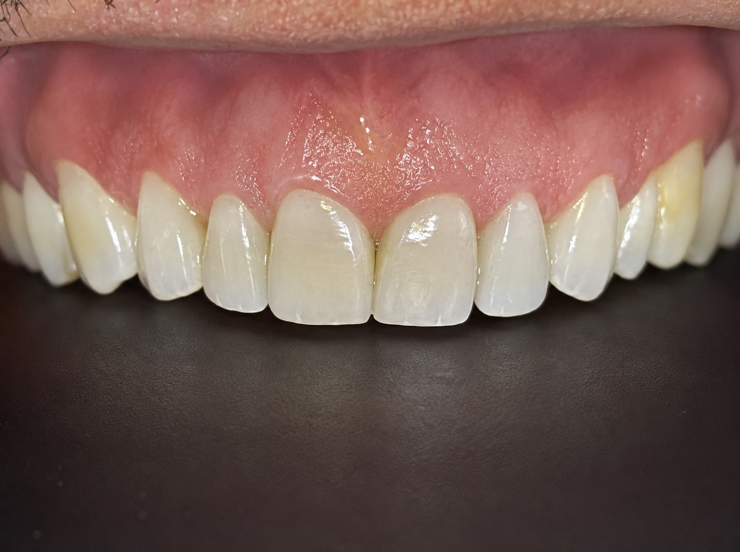 Resultado final de la restauración dental colocada